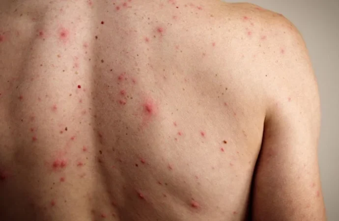 Jalisco impone uso obligatorio de cubrebocas en escuelas ante brote de sarampión